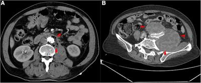 Strategies and outcomes of different methods for treating abdominal aortic stent graft infection